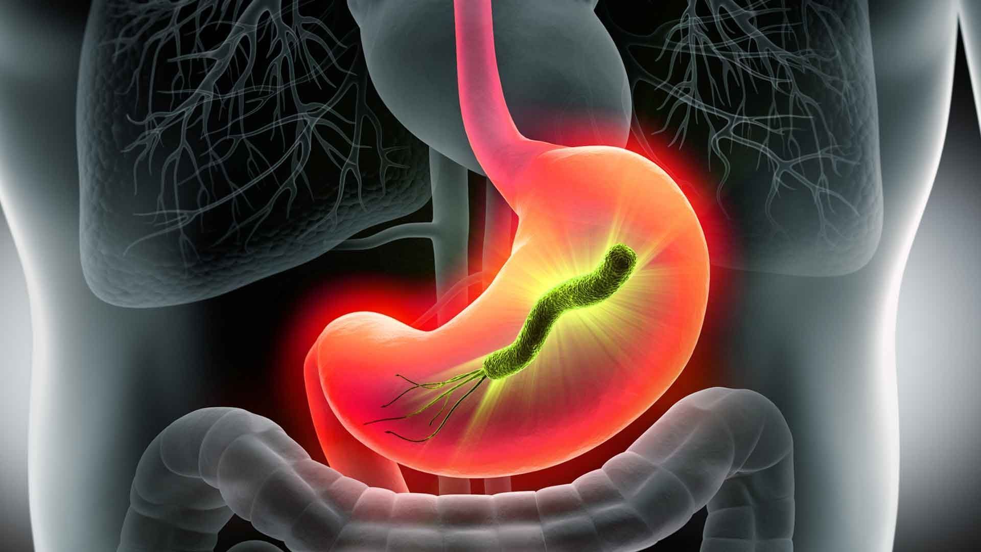 Understanding Gastritis: 5 Triggers You Should Know
